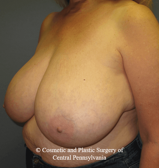 Breast Reduction Before