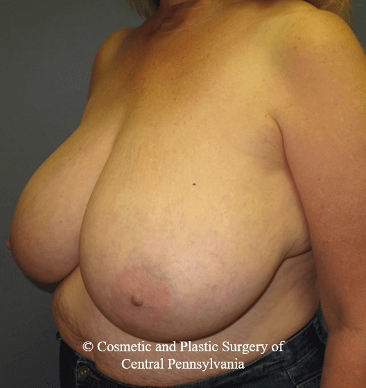 Breast Reduction Before