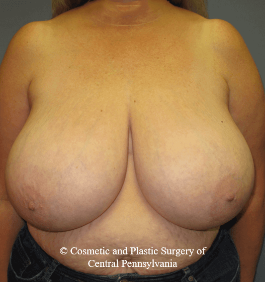 Breast Reduction Before