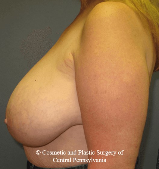 Breast Reduction Before