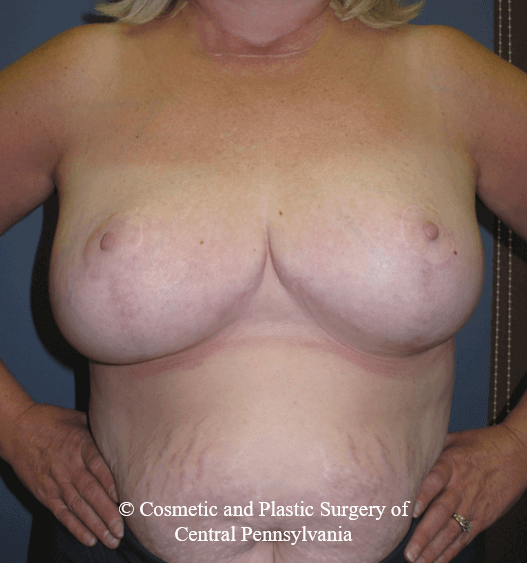 Breast Reduction After