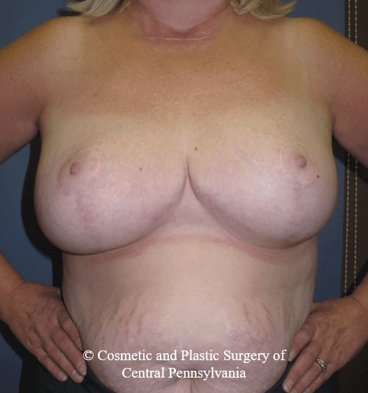 Breast Reduction After