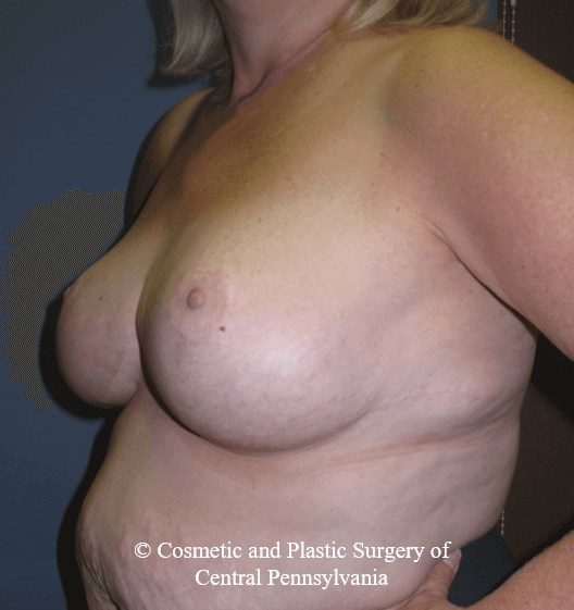 Breast Reduction After