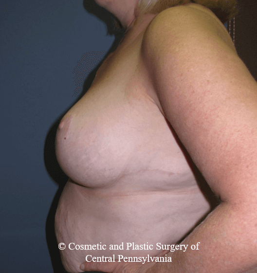 Breast Reduction After