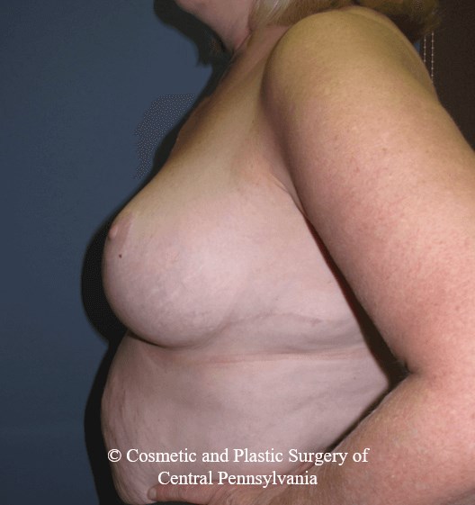 Breast Reduction After