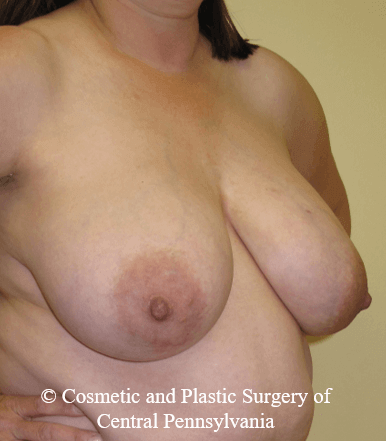 Breast Reconstruction Before
