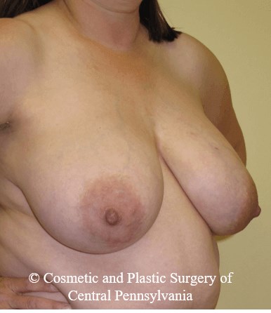 Breast Reconstruction Before