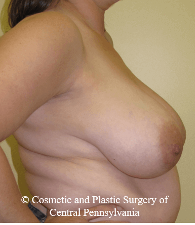 Breast Reconstruction Before