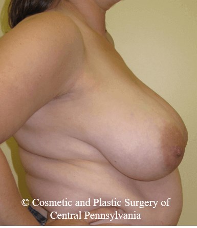 Breast Reconstruction Before