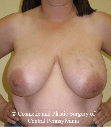 Breast Reconstruction Before