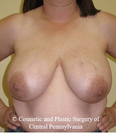 Breast Reconstruction Before