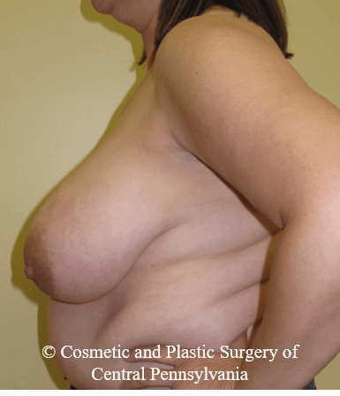Breast Reconstruction Before