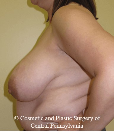 Breast Reconstruction Before