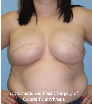 Breast Reconstruction After