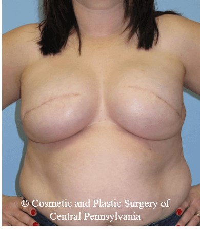 Breast Reconstruction After