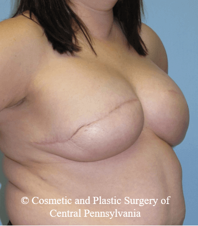 Breast Reconstruction After