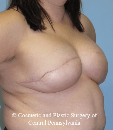 Breast Reconstruction After