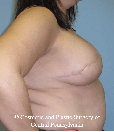 Breast Reconstruction After