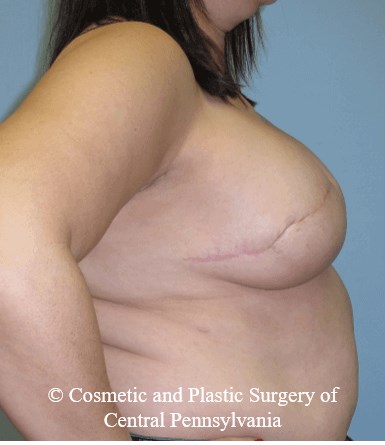 Breast Reconstruction After
