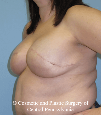 Breast Reconstruction After