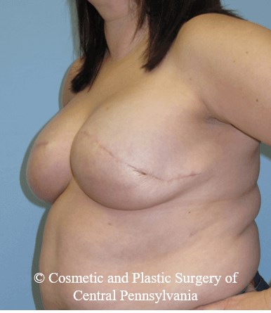 Breast Reconstruction After