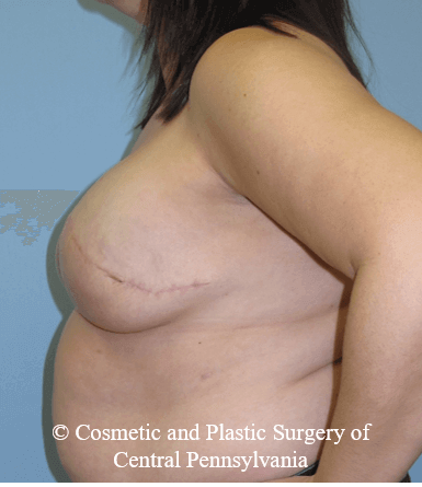 Breast Reconstruction After