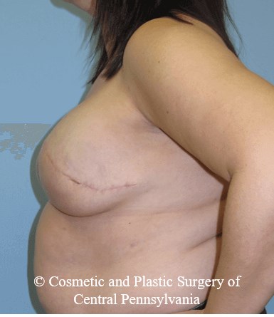 Breast Reconstruction After