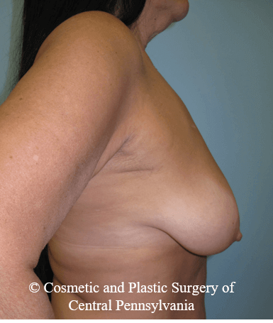 Breast Lift (Mastopexy) Before