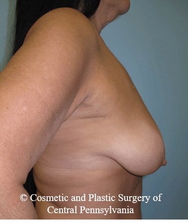 Breast Lift (Mastopexy) Before