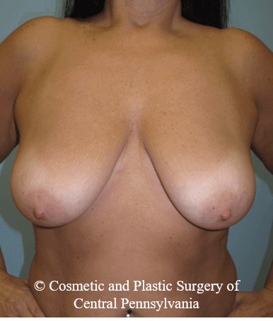 Breast Lift (Mastopexy) Before