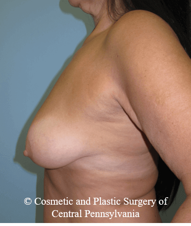 Breast Lift (Mastopexy) Before