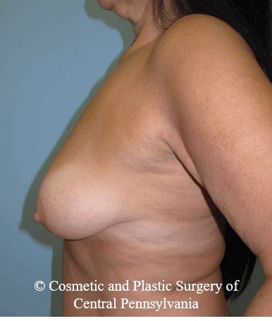 Breast Lift (Mastopexy) Before