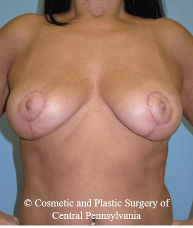 Breast Lift (Mastopexy) After