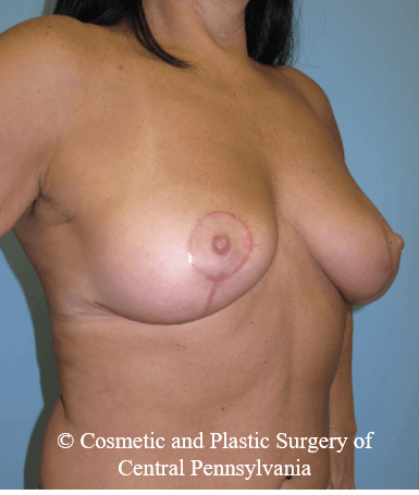 Breast Lift (Mastopexy) After