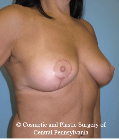 Breast Lift (Mastopexy) After