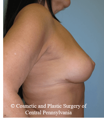 Breast Lift (Mastopexy) After