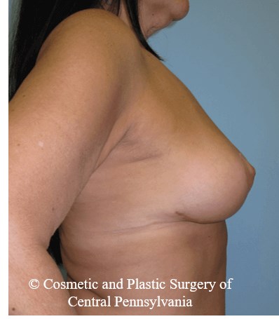 Breast Lift (Mastopexy) After