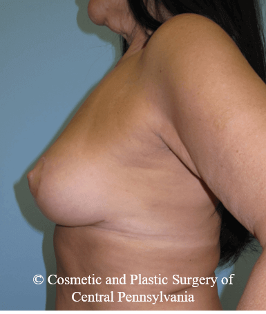 Breast Lift (Mastopexy) After