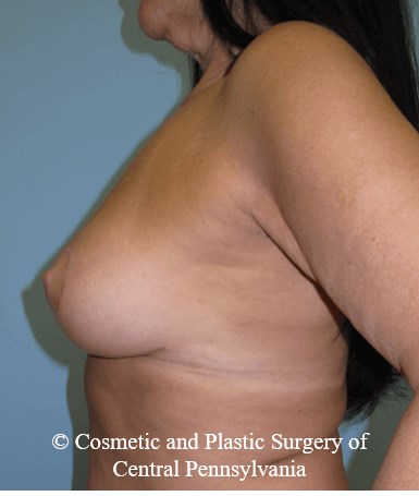 Breast Lift (Mastopexy) After