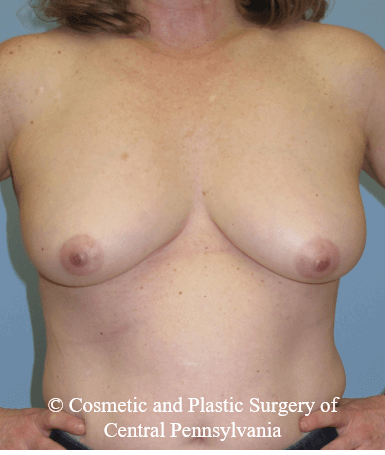 Breast Reconstruction Before