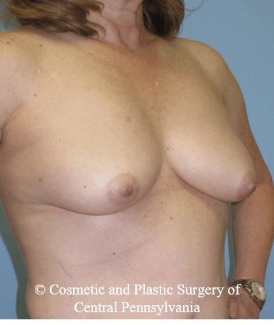 Breast Reconstruction Before