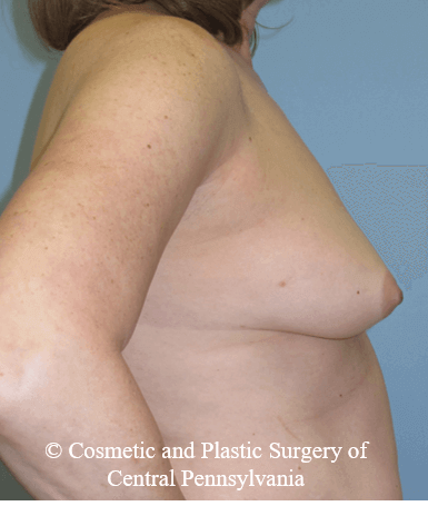 Breast Reconstruction Before