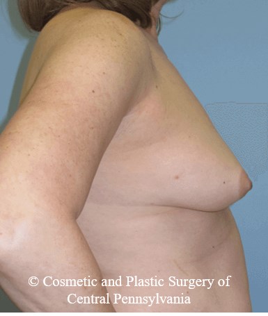 Breast Reconstruction Before