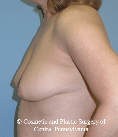 Breast Reconstruction Before