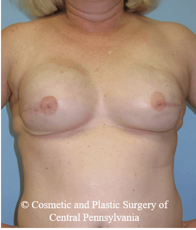 Breast Reconstruction After