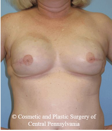 Breast Reconstruction After