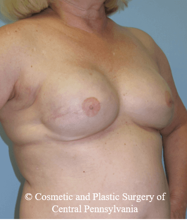 Breast Reconstruction After