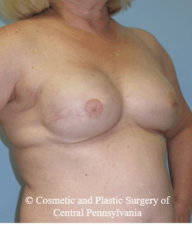 Breast Reconstruction After