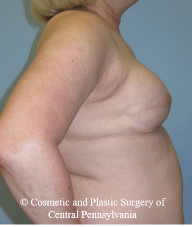 Breast Reconstruction After