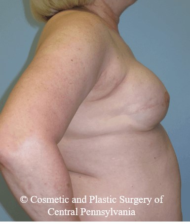 Breast Reconstruction After